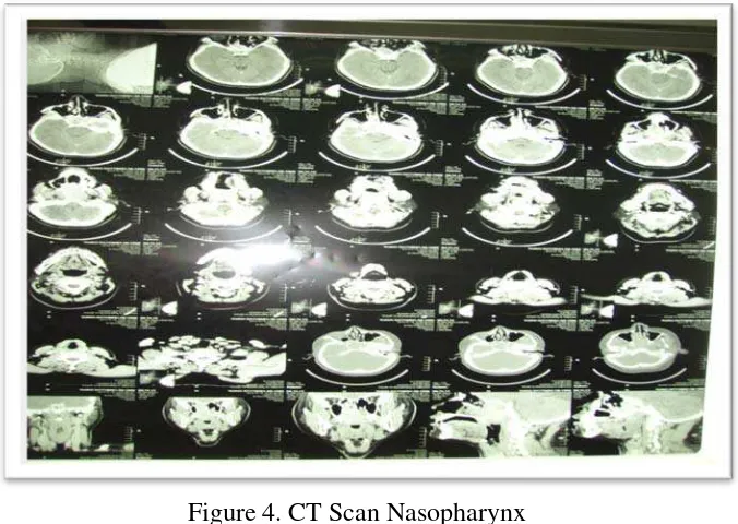 Figure 4. CT Scan Nasopharynx 