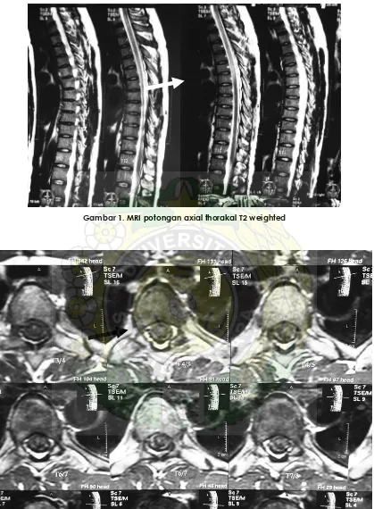 Gambar 1. MRI potongan axial thorakal T2 weighted 