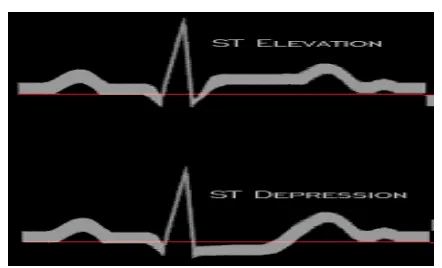 Gambar 3. EKG ST elevasi dan ST depresi 