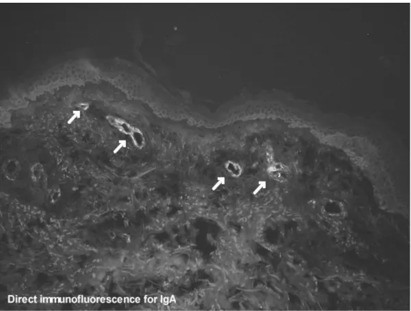 Gambar 3. Gambar mikroskopis Henoch Schonlein Purpura. Vasculitis dengan infiltrasi sel neutrofil dan debris nekrotik pada dinding pembuluh darah kecil