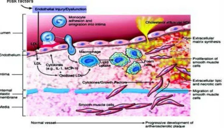 Gambar 2.2. Patogenesis inflamasi pada aterosklerosis. 