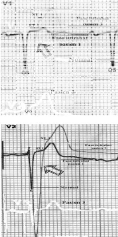 Gambar 10. Grafik EKG kompleks QS pada lead V1 dan V2  yang  menandakan  pasien  mengalami  penyakit  infark anteroseptal MI.