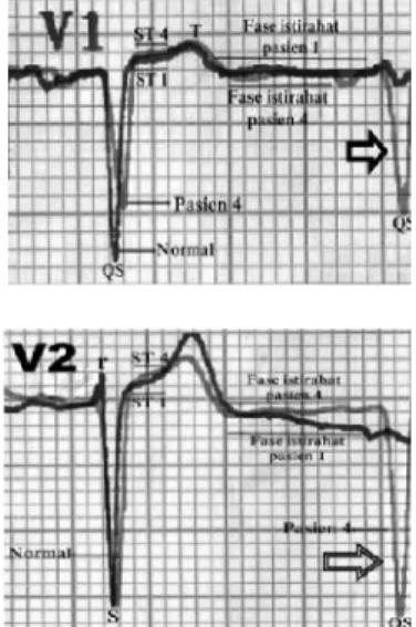Gambar 11. Grafik EKG lead II, III dan aVF pada pasien 4