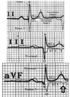 Gambar 14. Grafik EKG lead II, III dan aVF pada pasien 5