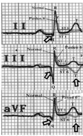 Gambar 15. Grafik EKG Lead II, III dan aVF pada pasien 6