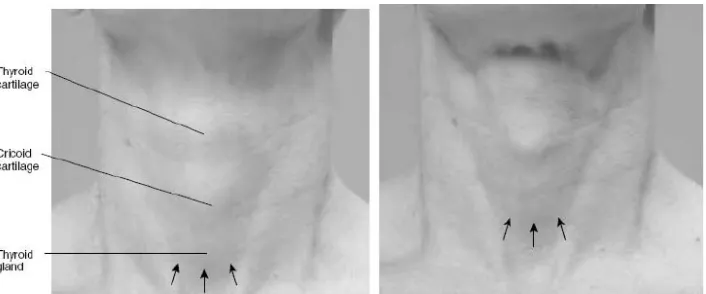 Gambar 7. Inspeksi kelenjar tiroid, kiri : saat istirahat, kanan : pada gerakan menelan