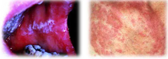 Gambar 2.3:  Infeksi Jamur pada pasien AIDS 