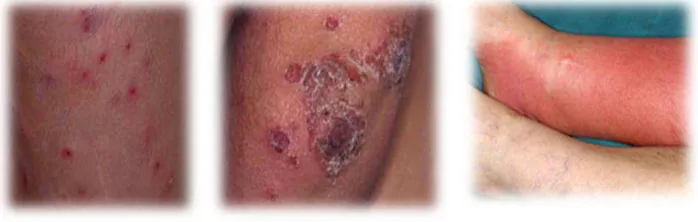 Gambar 2.4 Infeksi bakteri pada pasien AIDS 