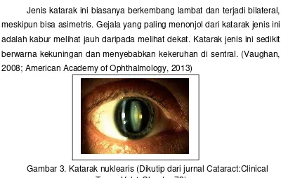 Gambar 2. Katarak Kortikal (Dikutip dari jurnal Cataract:Clinical 