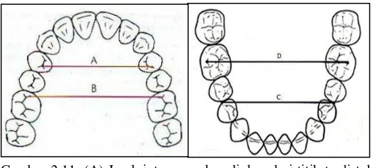Gambar 2.11. (A) Jarak interpremolar  diukur dari titik terdistal cekung mesial pada oklusal gigi premolar pertama maksila ke titik yang sama pada sisi yang berlainan, (B) jarak intermolar diukur dari titik cekung mesial pada permukaan oklusal pada gigi molar pertama maksila ke titik yang sama pada sisi yang berlainan, (C) jarak interpremolar diukur dari titik kontak antara gigi premolar satu dan gigi premolar dua mandibula ke titik yang sama pada sisi yang berlainan, (D) jarak intermolar diukur dari titik puncak cusp mesiobukal molar satu permanen mandibula ke titik yang sama pada sisi yang berlainan.5,14 