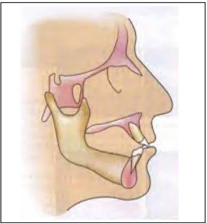 Gambar 2.6. Klas I Skeletal divisi 413 