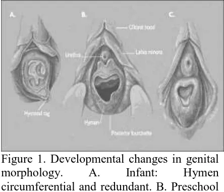 Figure 1. Developmental changes in genital morphology. A. Infant: Hymen circumferential and redundant