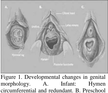 Figure 1. Developmental changes in genital morphology. A. Infant: Hymen circumferential and redundant