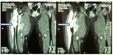 Gambar 2. Gambaran MRI femur kanan dengan dan tanpa 
