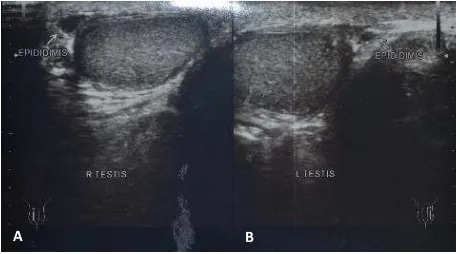 Gambar 3. Hasil USG testis kanan (A) dan kiri (B) yang menunjukkan hasil testis normal