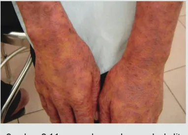 Gambar 9.11: ruam kemerahan pada kulit daerah tangan. Digunakan dengan ijin layanan HIV, Family Health International, Vietnam