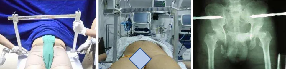 Figure 1. C-clamp insertion under local anesthesia in ER. Two pins were each screwed at sacroiliac left and right (inserting point is the intersection between vertical line passing Spina Iliac Anterior Superior and horizontal line through axis of the femur