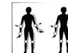 Gambar 5. Sensory Ataxia 