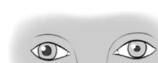 Gambar 18. Pupil anisokor  