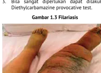 Gambar 1.3 Filariasis