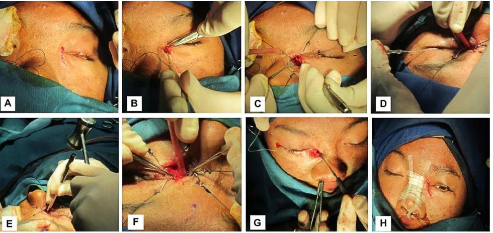 Figure 3. A) A 20 mm skin incision 4 mm from medial canthus; B) Tissue undermined to identify periosteum; C) Separation of periosteum and lacrimal sac to expose medial lacrimal fossa; D) Probing to identify sac lumen; E) Osteotomy; F) Anterior and posterior flap from both lacrimal sac and nasal mucosa were made; G) Silicone tube insertion; H) Skin incision was closed