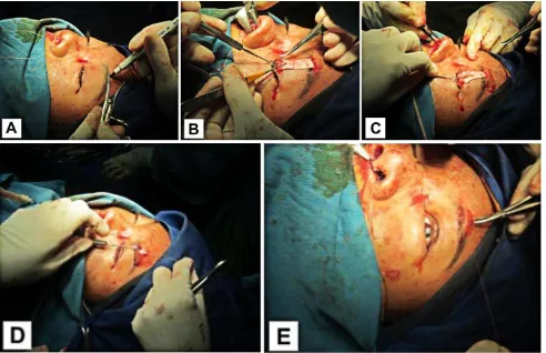 Figure 5. A) Upper lid skin crease and upper brow incision was marked; B) and C) Fascia lata inserted and sutured into the tarsal; D) Superior traction of the fascia lata through the tunnel; E) Skin incision was closed