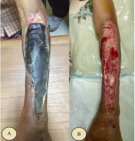 Figure 4. Six-week evaluation of honey treatment. (A) After zation was seen from the edge of the wound