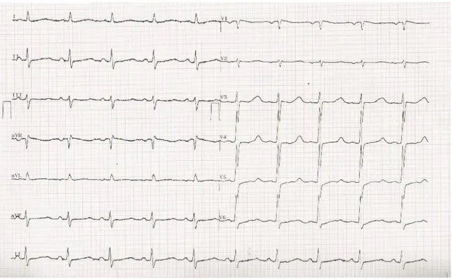 Gambar 2. Rekaman EKG 12 sadapan inisial ketika pasien tiba di IGD 