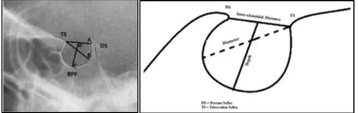 Gambar 9. Morfologi normal sella tursika dan garis referensi yang digunakan untuk mengukur sella: TS: tuberkulum sella; DS: dorsum sella; BPF:base of the pituitary fossa