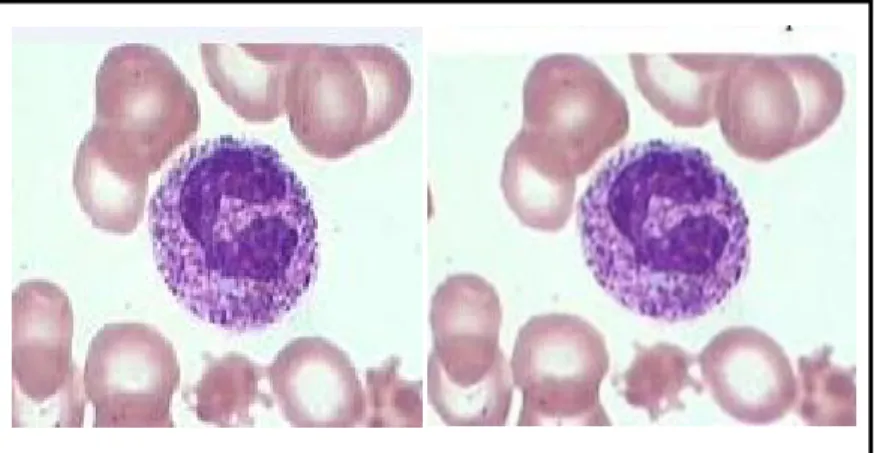 Gambar 2.7 Granula toksik neutrofil   pada pemeriksaan hapusan darah tepi 