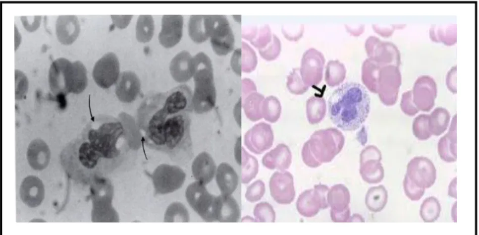 Gambar 2.8 Vakuola toksik neutrofil   pada pemeriksaan hapusan darah tepi 