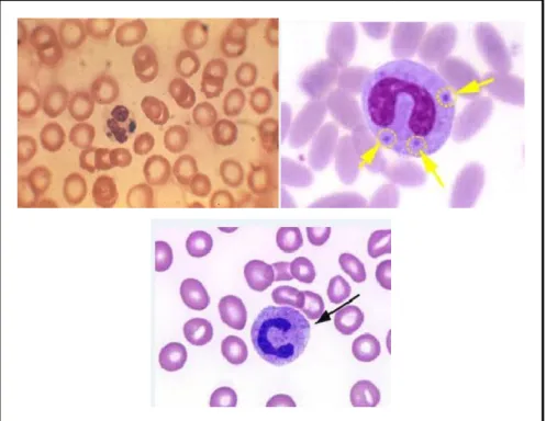 Gambar 2.9 Badan Dohle neutrofil   pada hapusan darah tepi  (Dikutip dari Alqep, 2009) 