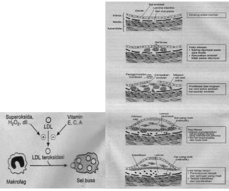 Gambar 8.11 Pembentukan aterosklerosis 