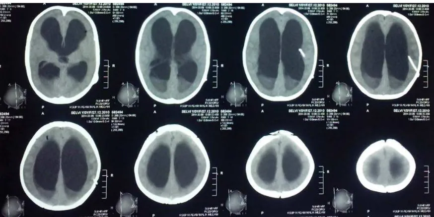 Gambar. CT-scan kepala menunjukan lesi hiperdens intraventrikel dengan dilatasi seluruh 