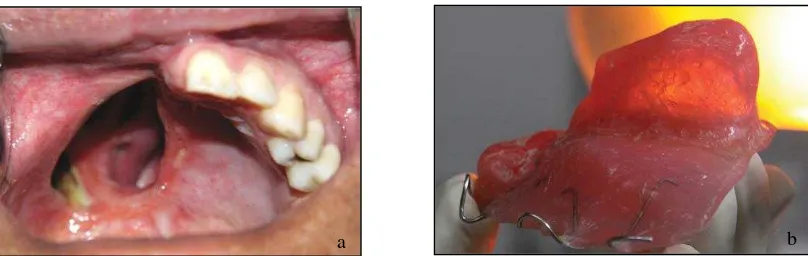 Gambar 2.4 (a) Defek maksila pasca hemimaksilektomi; (b) Hollow bulb interim obturator      (Daniel, 2015) 