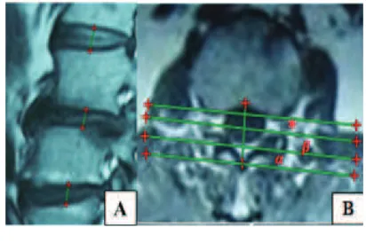 Fig. 1Lumbar Herniated Disc on Sagittal T2 Weighted Image , A) Axial T2 Weighted Image (red asterixs)