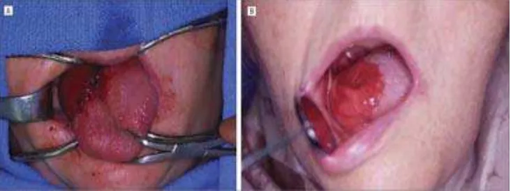 Gambar 7. (a) Hemiglosektomi (b) 1 tahun setelah dilakukannya hemiglosektomi (Anand VK