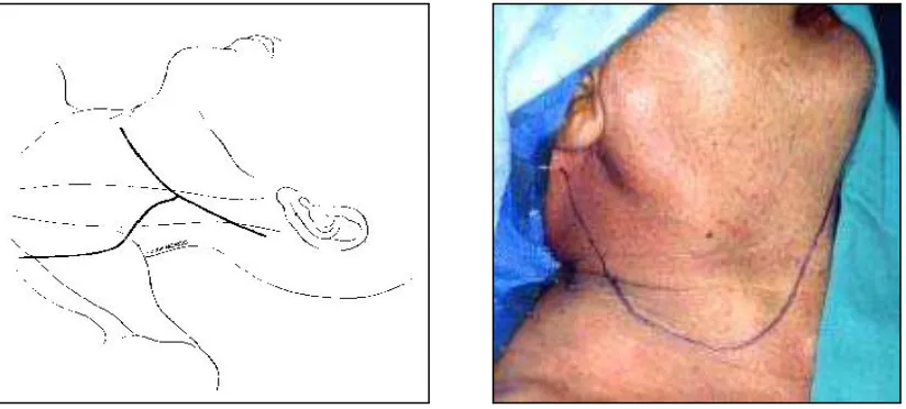 Gambar 8. Desain Flep Apron (Shaha AR, Werning J. Radical neck dissection. 2004) (http://emedicine.medscape.com/) (18 Mei 2011) 