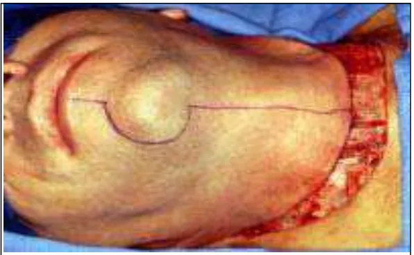 Gambar 9. Diseksi bilateral. (Werning J. Modified radical neck dissection. 2010) (http://emedicine.medscape.com/)  (18 Mei 2011) 