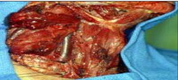 Gambar 15. Penjepitan dan insisi vena jugularis internal. (Werning J. Modified radical  neck dissection