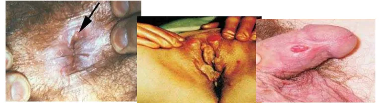 Gambar 13. Ulkus Sifilis Primer 