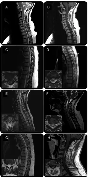 Figure 1MRI of representative cases of acute and subacute myelopathies