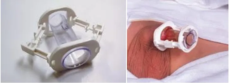 Gambar alat smart clamp dan alat yang sudah terpasang pada penis 