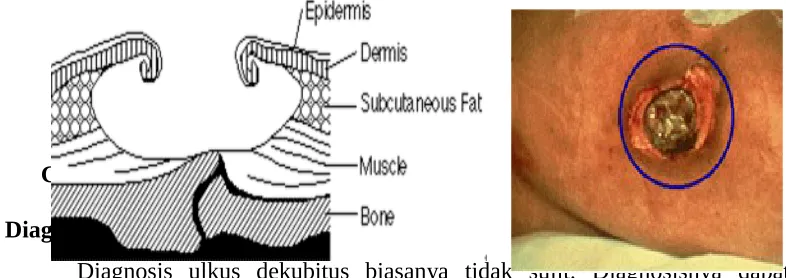 Gambar 3. Stadium 4 Ulkus Dekubitus