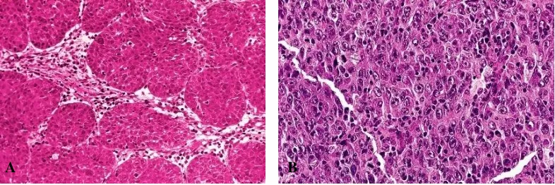 Gambar 2.7. sarang-sarang padat. B. Tipe Undifferentiated carcinoma. A. Tipe Regauds, terdiri dari sel-sel yang membentuk Schminke, terdiri sel-sel yang tumbuh membentuk gambaran syncytial yang difus (dikutip dari Rosai J