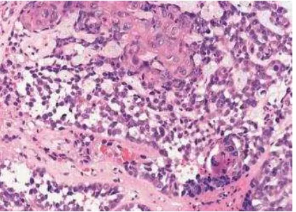 Gambar 2.8. JKC,Bray F, McCarron. Pathology and Genetic Head and Neck Tumours)festooningBasaloid squamous cell carcinoma