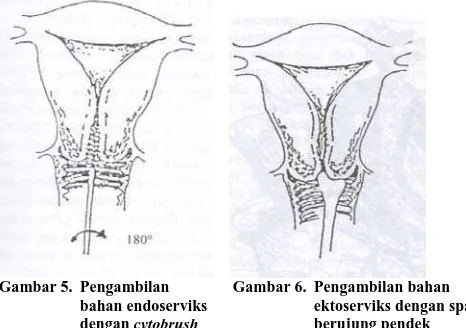 Gambar 5.  Pengambilan   bahan endoserviks 