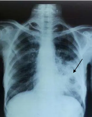 Gambar 6. Gambaran Foto Rontgen Pasien TB Paru dengan Diabetes Melitus 