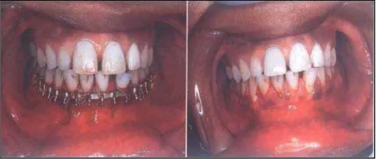 Gambar 3. Penanganan fraktur dentoalveolar anterior 