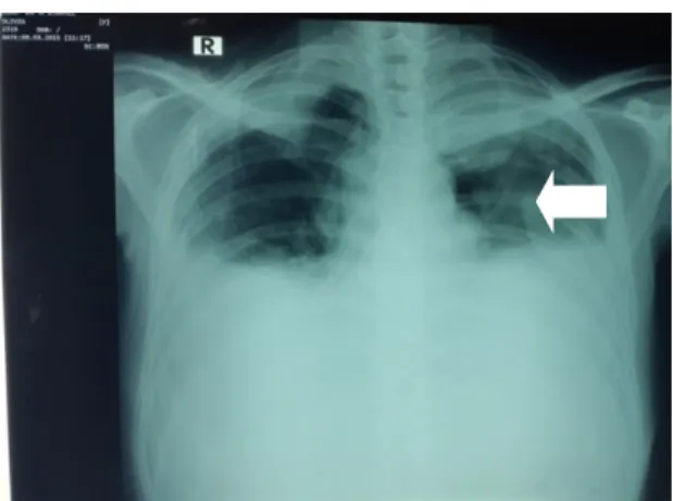 Gambar 2.  CT Scan kepala memperlihatkan massa 